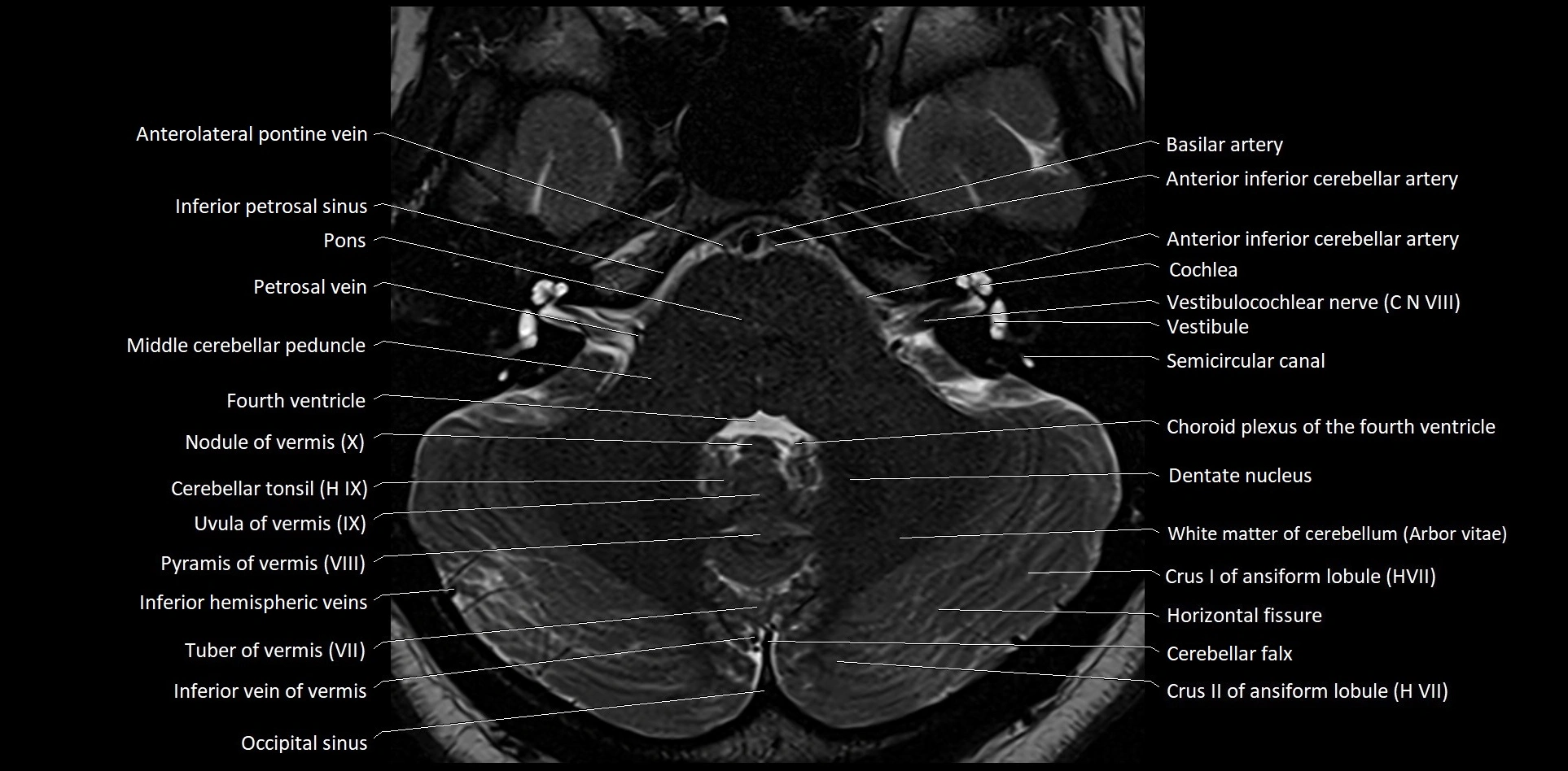 MRI Cerebellar anatomy High-resolution labelled 3T MRI image 12.webp